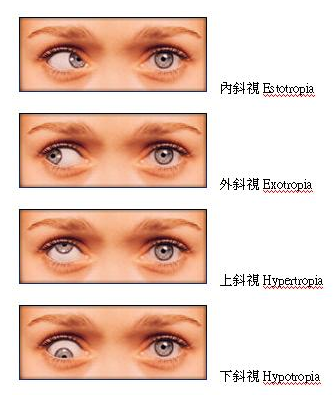 你有斜視嗎 斜視手術前還有這些矯正方法 元新眼科